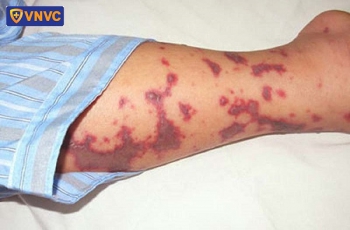 Cảnh báo các ca bệnh não mô cầu xâm lấn: Bệnh không phổ biến nhưng rất nguy hiểm